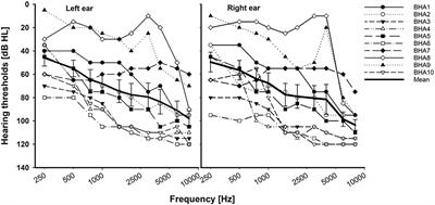 Effects of the intensified frequency and time ranges on consonant enhancement in bilateral cochlear implant and hearing aid users